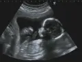 USG płodu, profil dziecka. Wczesne objawy zespołu Edwardsa mogą być widoczne na tym obrazie.