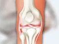 Anatomia ludzkiego kolana z widocznymi kośćmi, więzadłami i chrząstkami.