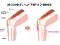 Ilustracja anatomiczna kolana pokazująca zapalenie ścięgna rzepki w chorobie Osgooda-Schlattera.