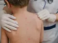 Dziecko z wysypką ospową na plecach, badane przez lekarza w rękawiczkach.