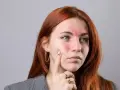 Kobieta z zaczerwienioną twarzą i wysypką na policzkach i czole.