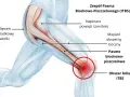 Anatomia kolana z zaznaczonym pasmem biodrowo-piszczelowym i obszarem bólu.