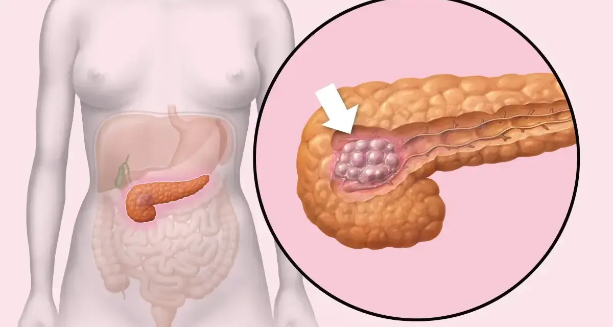 Ilustracja pokazuje trzustkę z guzem. W Polsce są najlepsi lekarze od trzustki, którzy pomagają pacjentom.