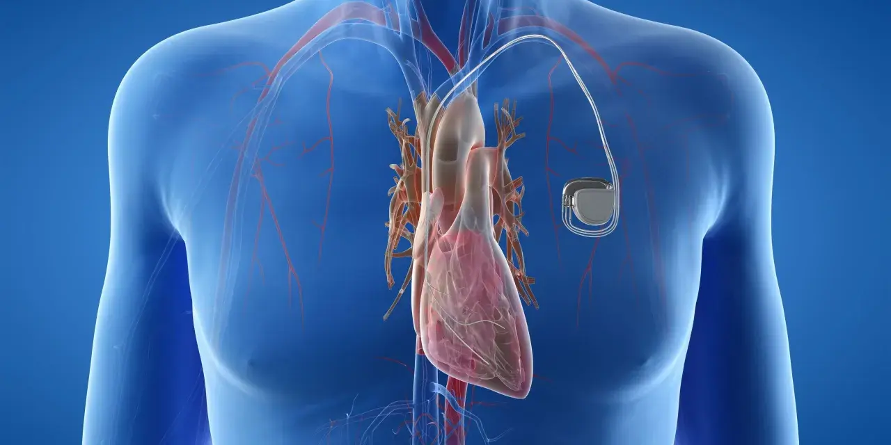 Anatomical illustration of a human heart with a pacemaker. Zastanawiasz się, ile się czeka na wszczepienie rozrusznika serca?