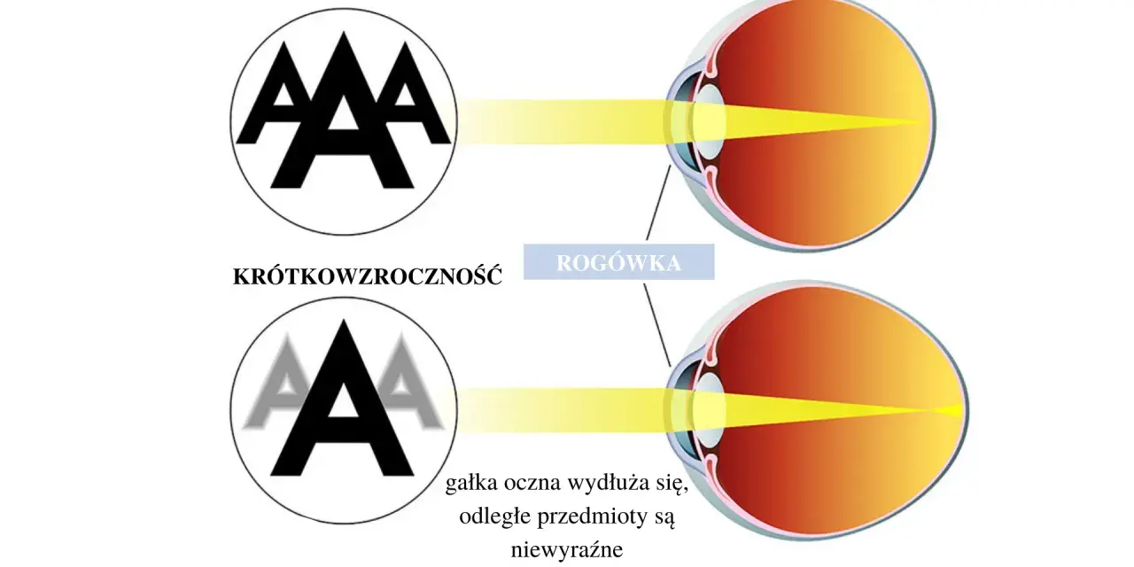 Ilustracja porównująca oko zdrowe z krótkowzrocznym, pokazująca skupienie światła.