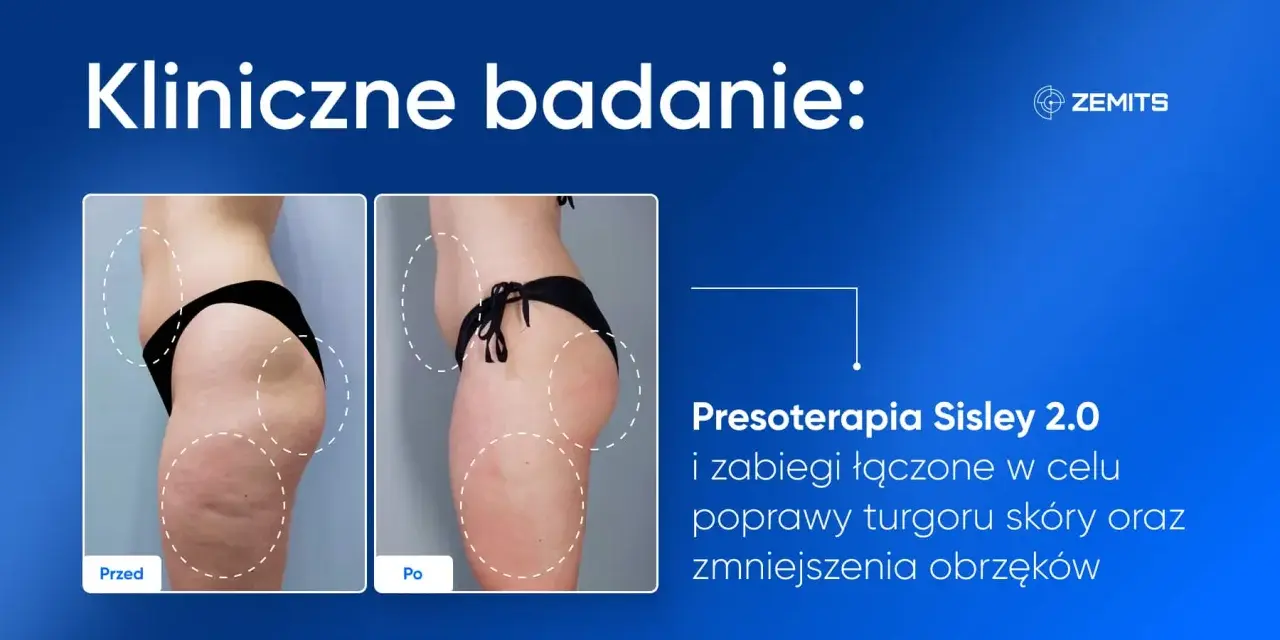 Porównanie sylwetki przed i po presoterapii, ukazujące redukcję obrzęków i poprawę napięcia skóry.