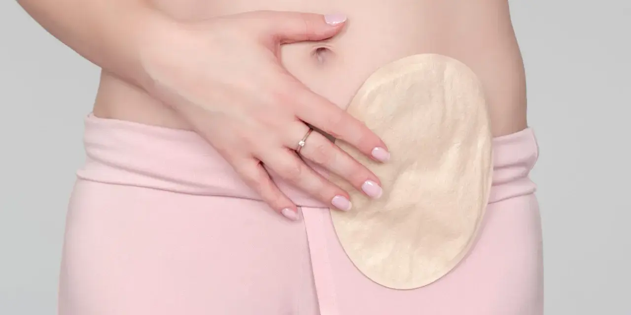 Kobieta z przyklejoną do brzucha płytką stomijną. To rozwiązanie, które pomaga w życiu z ileostomią.