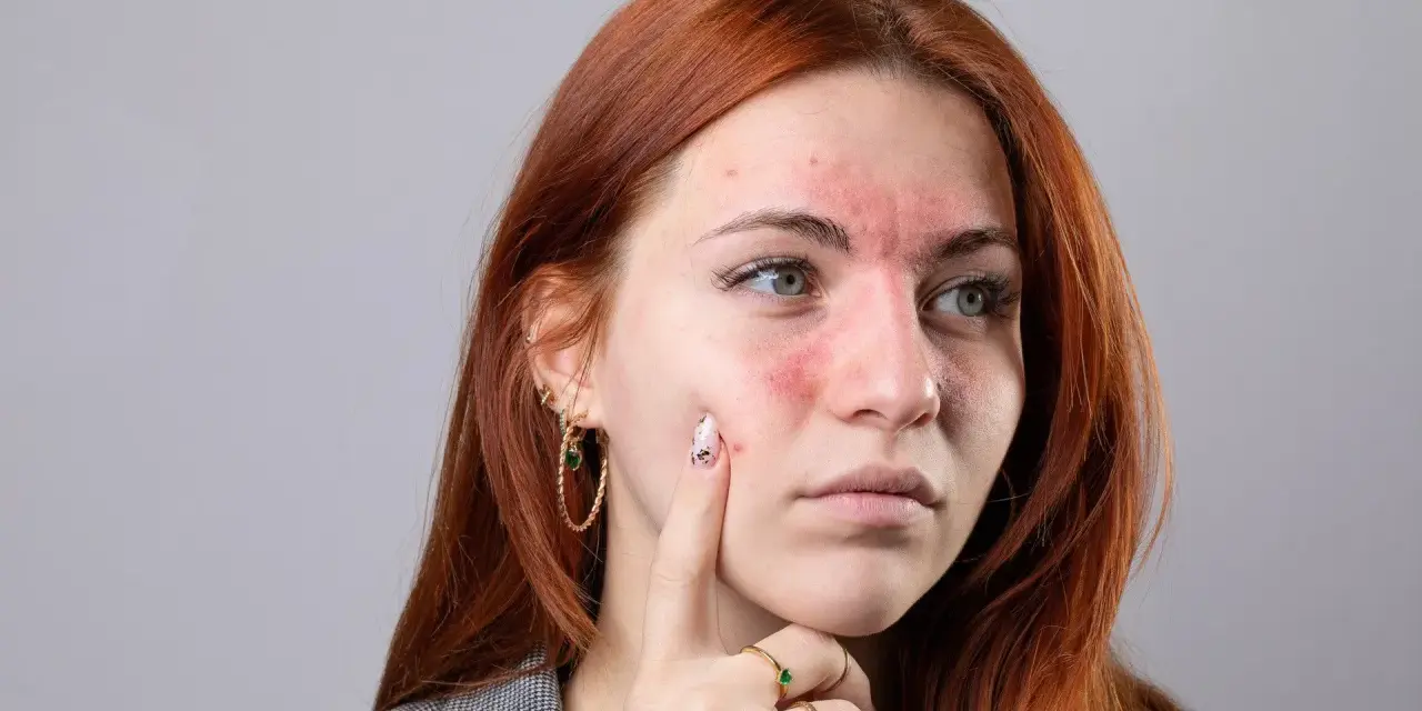 Kobieta z zaczerwienioną twarzą i wysypką na policzkach i czole.