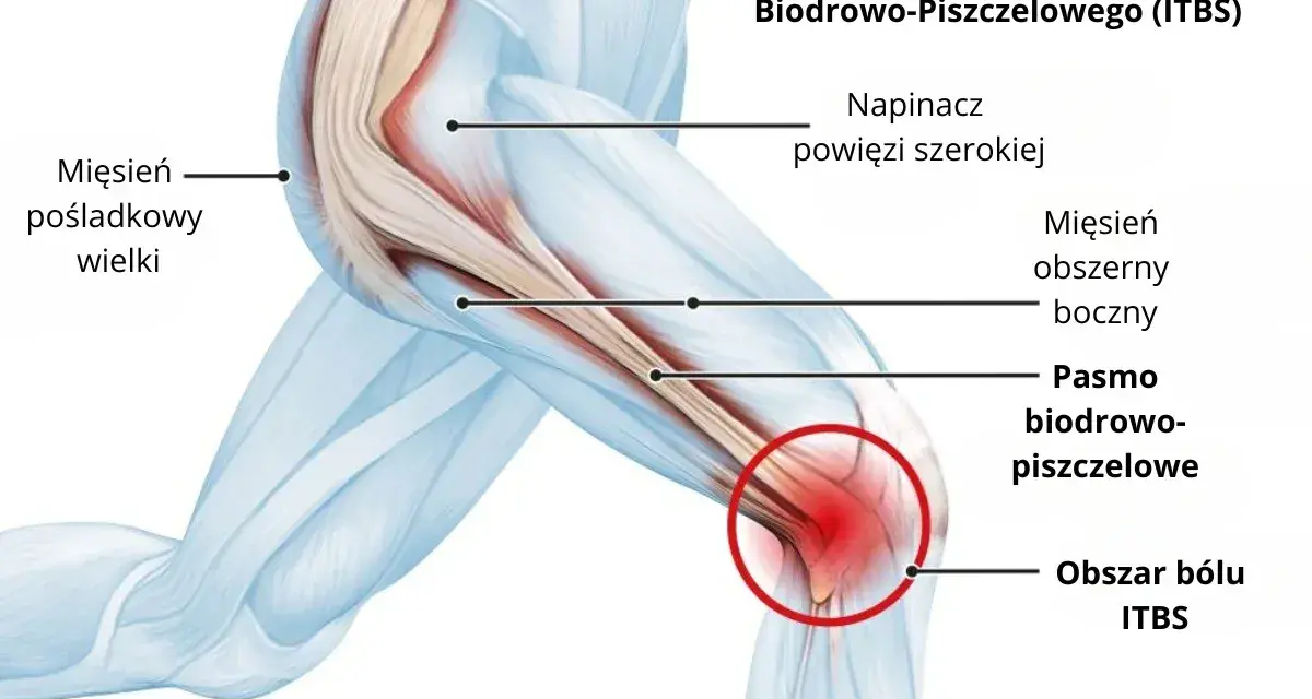 Anatomia kolana z zaznaczonym pasmem biodrowo-piszczelowym i obszarem bólu.