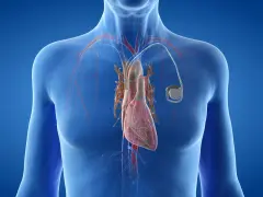 Anatomical illustration of a human heart with a pacemaker. Zastanawiasz się, ile się czeka na wszczepienie rozrusznika serca?