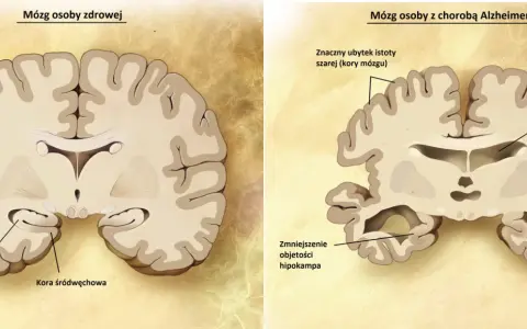 Porównanie mózgu zdrowego z mózgiem osoby z chorobą Alzheimera, ukazujące zanik kory mózgowej i hipokampa, typowe dla chorób neurodegeneracyjnych.