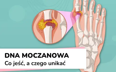 Dna moczanowa: powiększony staw palucha z kryształkami kwasu moczowego. Objawy dny moczanowej mogą być bolesne.