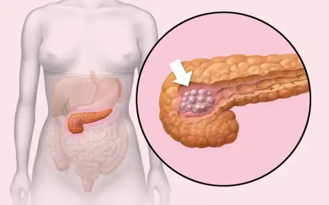 Ilustracja pokazuje trzustkę z guzem. W Polsce są najlepsi lekarze od trzustki, którzy pomagają pacjentom.