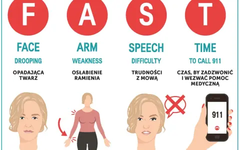 Objawy wylewu u kobiet: opadająca twarz, osłabienie ramienia, trudności z mową. Czas to życie, dzwoń pod 911!