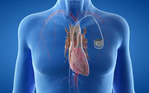 Anatomical illustration of a human heart with a pacemaker. Zastanawiasz się, ile się czeka na wszczepienie rozrusznika serca?