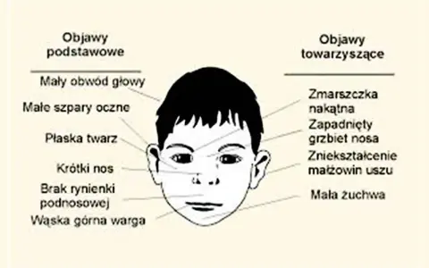 Ilustracja twarzy dziecka z zaznaczonymi cechami FAS: mały obwód głowy, płaska twarz, krótki nos, wąska warga.