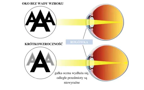 Ilustracja porównująca oko zdrowe z krótkowzrocznym, pokazująca skupienie światła.