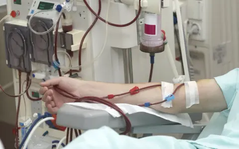 Ramię pacjenta podłączone do aparatury dializacyjnej.