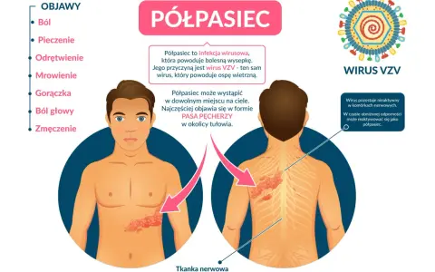Ilustracja przedstawia objawy półpaśca na ciele człowieka: wysypkę na tułowiu i plecach, wirusa VZV oraz listę objawów.
