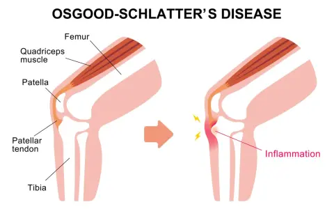 Ilustracja anatomiczna kolana pokazująca zapalenie ścięgna rzepki w chorobie Osgooda-Schlattera.