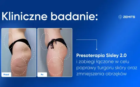 Porównanie sylwetki przed i po presoterapii, ukazujące redukcję obrzęków i poprawę napięcia skóry.