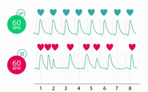 Dwa wykresy EKG pokazują rytm serca. Górny wykres z zielonym sercem i 60 BPM jest prawidłowy. Dolny z czerwonym sercem i 60 BPM ma nieregularny rytm.