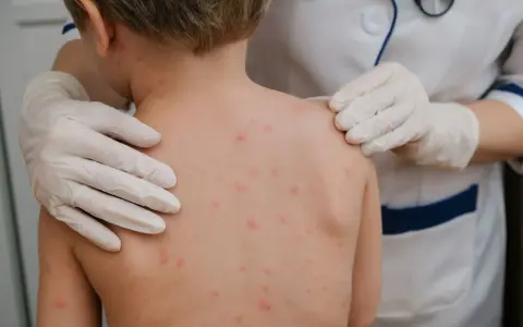 Dziecko z wysypką ospową na plecach, badane przez lekarza w rękawiczkach.