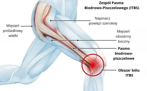 Anatomia kolana z zaznaczonym pasmem biodrowo-piszczelowym i obszarem bólu.