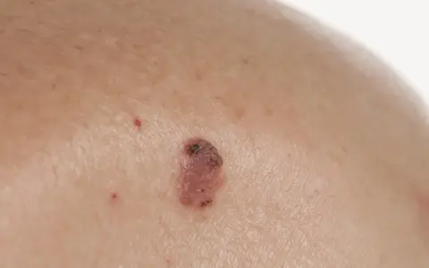 Zbliżenie na skórę z widocznym, nieregularnym znamieniem o różowo-brązowym zabarwieniu.