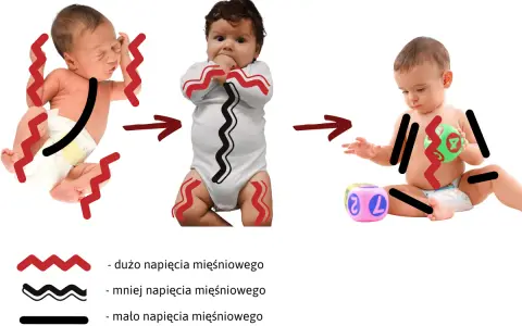 Zmiana napięcia mięśniowego u niemowląt: od dużego napięcia do mniejszego, a potem do małego.