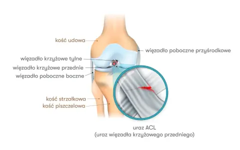 Anatomia kolana z zaznaczonym zerwanym więzadłem krzyżowym przednim (ACL).