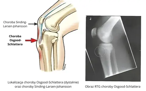 Ilustracja anatomiczna i RTG kolana pokazujące chorobę Osgooda-Schlattera, która objawia się guzowatością kości piszczelowej.