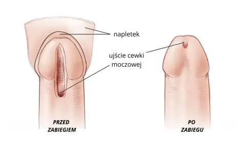 Ilustracja porównująca cewkę moczową przed i po zabiegu, z zaznaczonym napletkiem i ujściem cewki.