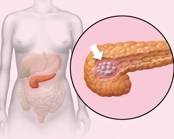 Ilustracja pokazuje trzustkę z guzem. W Polsce są najlepsi lekarze od trzustki, którzy pomagają pacjentom.