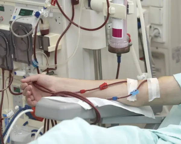 Ramię pacjenta podłączone do aparatury dializacyjnej.