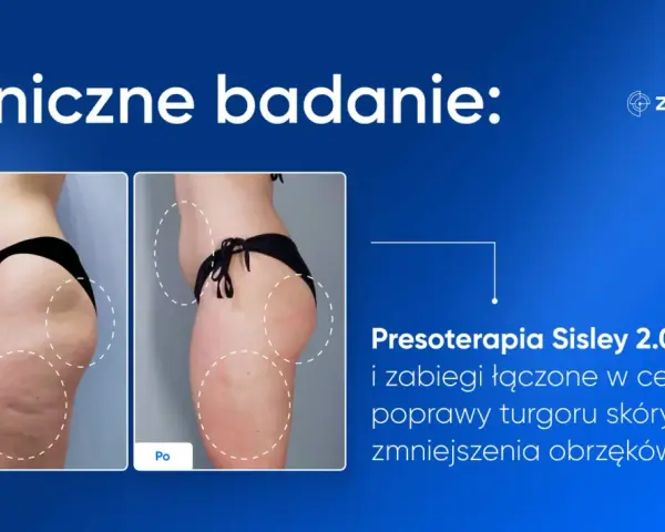 Porównanie sylwetki przed i po presoterapii, ukazujące redukcję obrzęków i poprawę napięcia skóry.