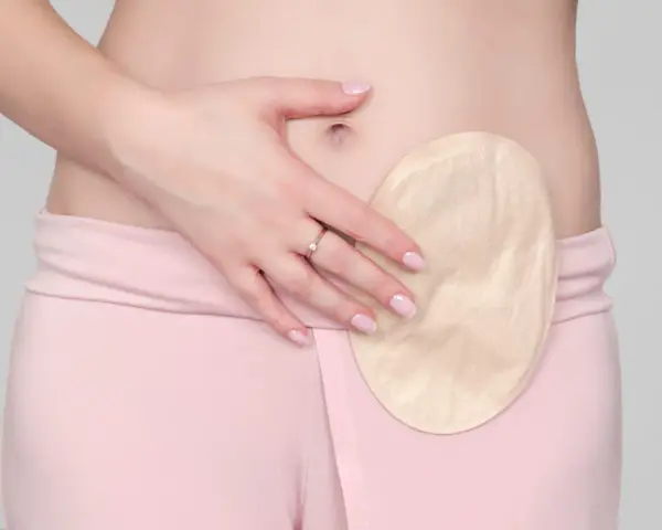 Kobieta z przyklejoną do brzucha płytką stomijną. To rozwiązanie, które pomaga w życiu z ileostomią.