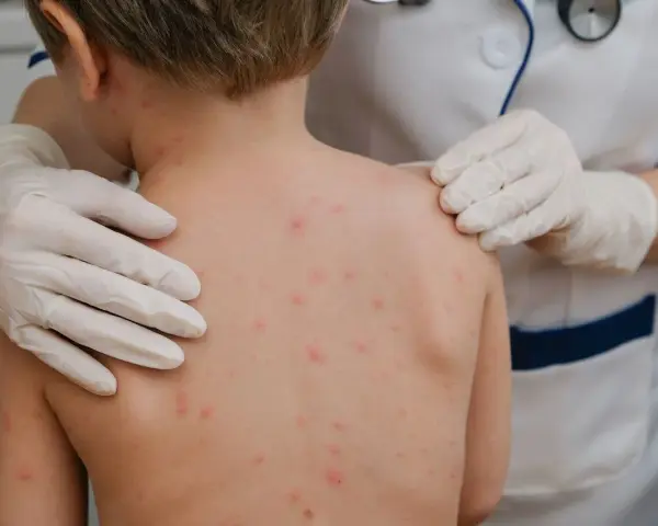Dziecko z wysypką ospową na plecach, badane przez lekarza w rękawiczkach.