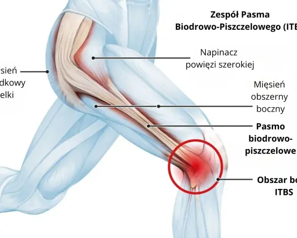 Anatomia kolana z zaznaczonym pasmem biodrowo-piszczelowym i obszarem bólu.