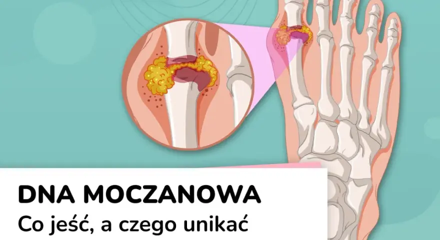 Dna moczanowa: powiększony staw palucha z kryształkami kwasu moczowego. Objawy dny moczanowej mogą być bolesne.