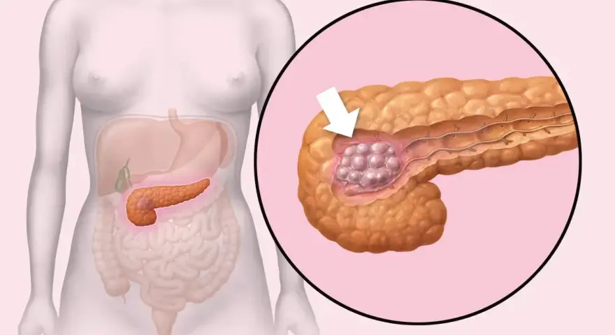 Ilustracja pokazuje trzustkę z guzem. W Polsce są najlepsi lekarze od trzustki, którzy pomagają pacjentom.