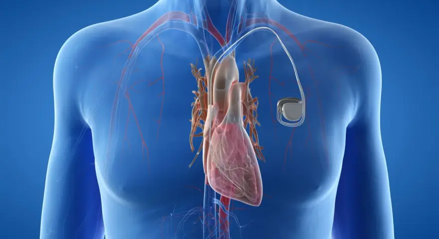 Anatomical illustration of a human heart with a pacemaker. Zastanawiasz się, ile się czeka na wszczepienie rozrusznika serca?