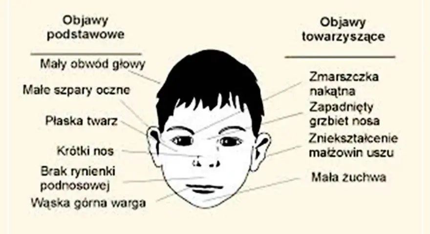 Ilustracja twarzy dziecka z zaznaczonymi cechami FAS: mały obwód głowy, płaska twarz, krótki nos, wąska warga.