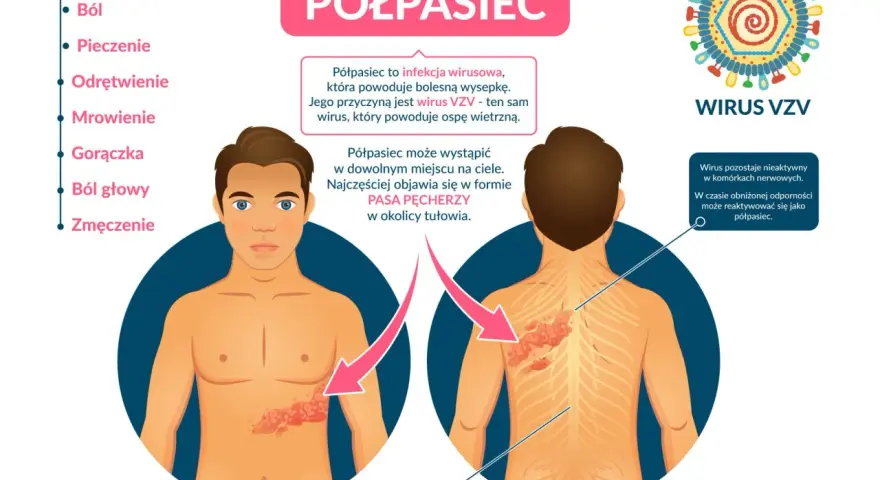 Ilustracja przedstawia objawy półpaśca na ciele człowieka: wysypkę na tułowiu i plecach, wirusa VZV oraz listę objawów.