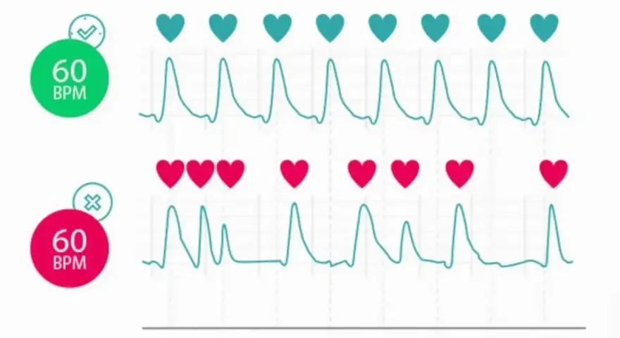Dwa wykresy EKG pokazują rytm serca. Górny wykres z zielonym sercem i 60 BPM jest prawidłowy. Dolny z czerwonym sercem i 60 BPM ma nieregularny rytm.