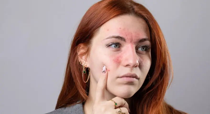 Kobieta z zaczerwienioną twarzą i wysypką na policzkach i czole.