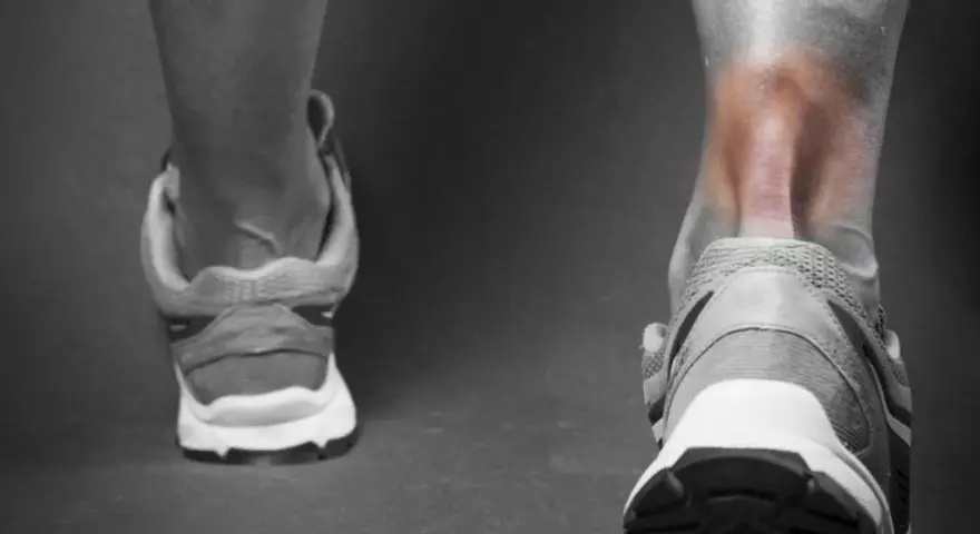 Ból w pięcie i łydce sugeruje zapalenie ścięgna Achillesa. Widok z tyłu na nogę w bucie sportowym, z zaczerwienionym obszarem.