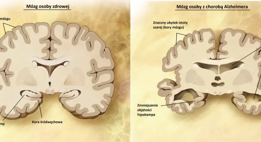 Porównanie mózgów: zdrowy vs. z chorobą Alzheimera. U chorych na Alzheimera widoczny ubytek kory mózgowej i hipokampa, co pokazuje, na co umierają chorzy na alzheimera.