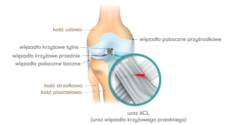 Anatomia kolana z zaznaczonym zerwanym więzadłem krzyżowym przednim (ACL).