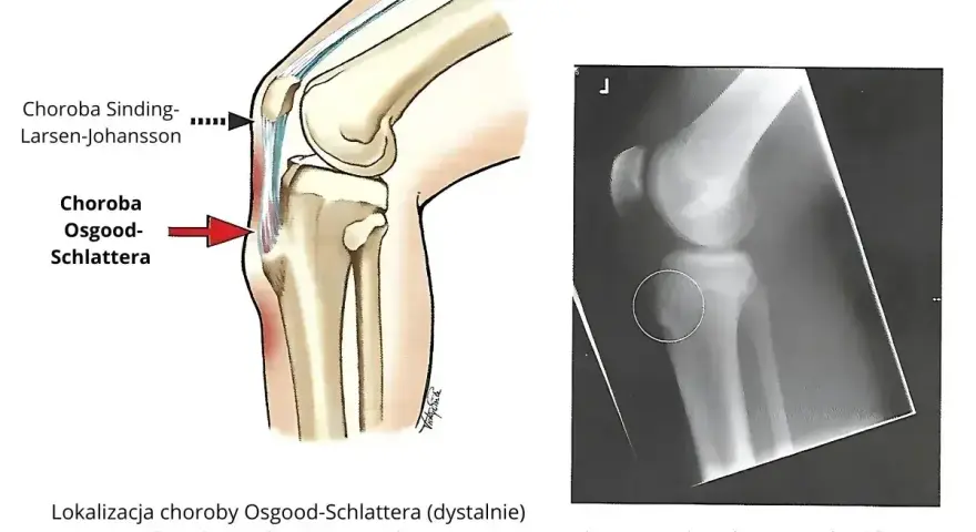 Ilustracja anatomiczna i RTG kolana pokazujące chorobę Osgooda-Schlattera, która objawia się guzowatością kości piszczelowej.